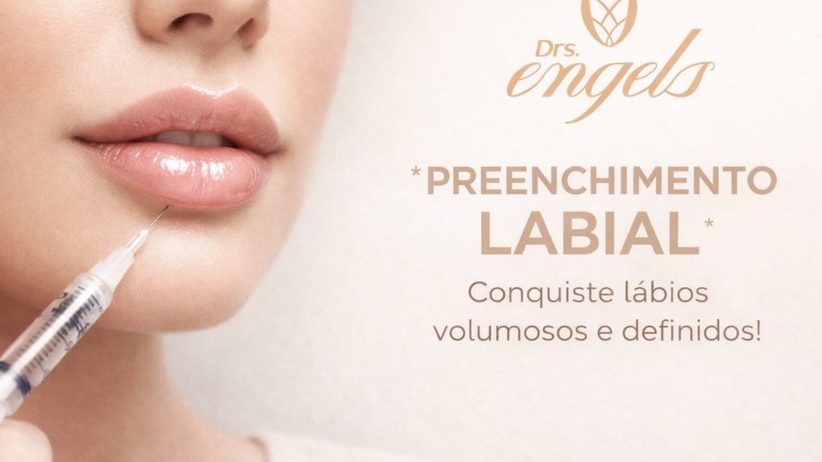 Paciente após PREENCHIMENTO LABIAL EM PONTA GROSSA com ácido hialurônico na Clínica DRS. Engels, resultado natural e harmonização facial.