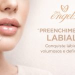 Paciente após PREENCHIMENTO LABIAL EM PONTA GROSSA com ácido hialurônico na Clínica DRS. Engels, resultado natural e harmonização facial.