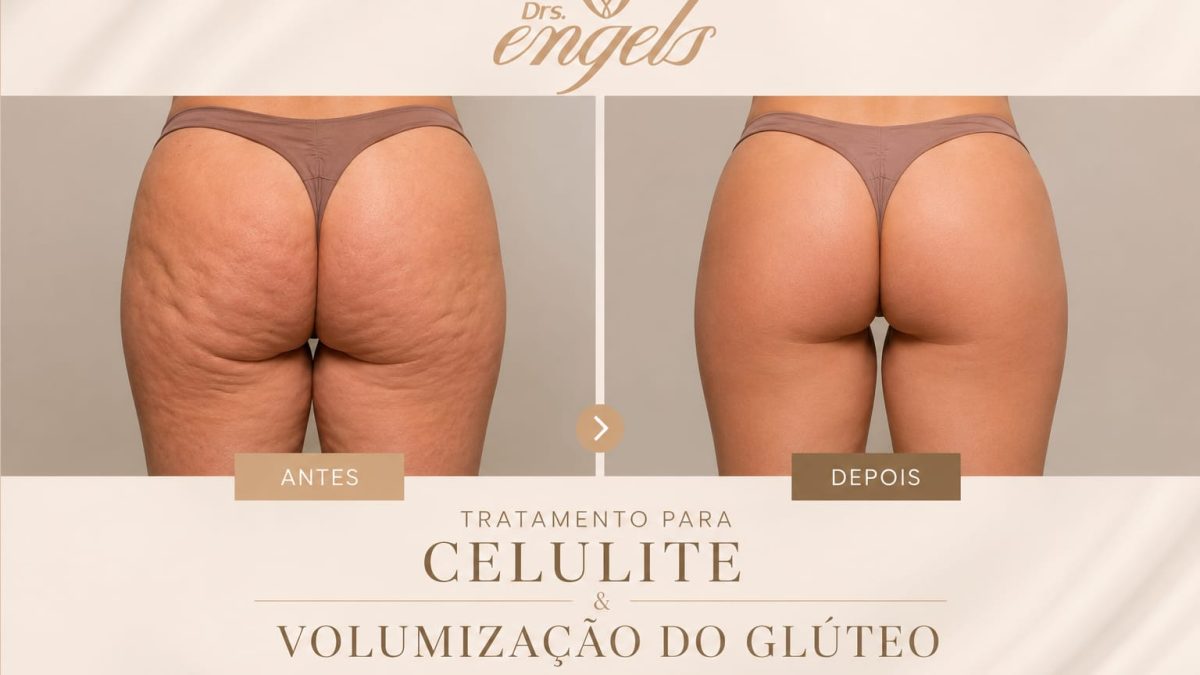 Preenchimento de glúteo: como funciona — profissional aplicando preenchimento para modelar glúteos com resultados naturais.