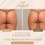 Preenchimento de glúteo: como funciona — profissional aplicando preenchimento para modelar glúteos com resultados naturais.