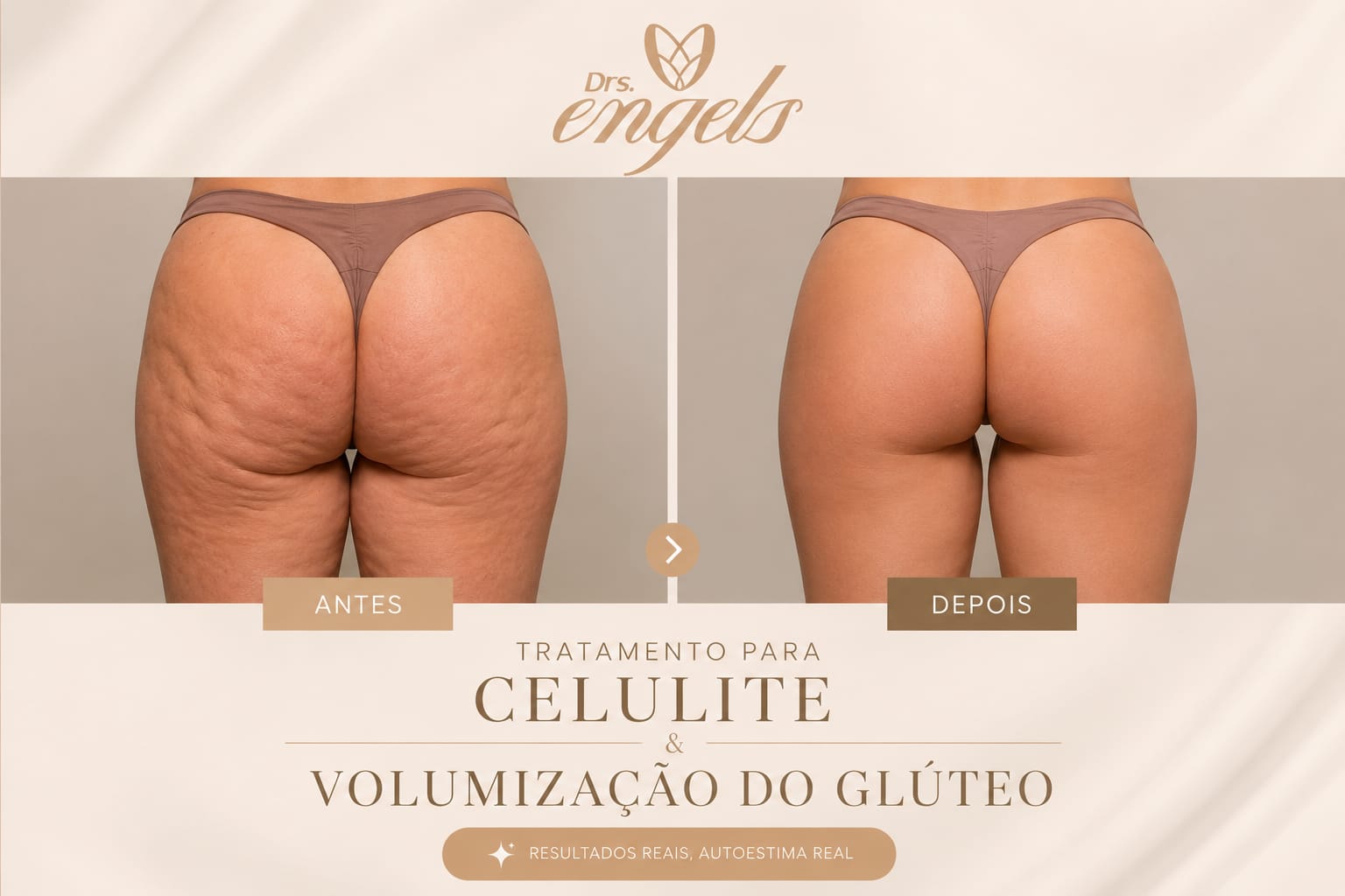 Preenchimento de glúteo: como funciona — profissional aplicando preenchimento para modelar glúteos com resultados naturais.